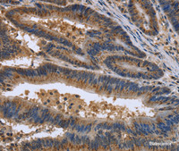 Immunohistochemistry of paraffin-embedded Human colon cancer using EPOR Polyclonal Antibody at dilution of 1:30