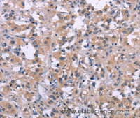Immunohistochemistry of paraffin-embedded Human thyroid cancer using MKP-1 Polyclonal Antibody at dilution of 1:30