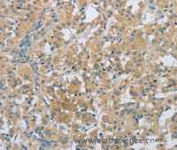 Immunohistochemistry of paraffin-embedded Human thyroid cancer tissue using PKD1 Polyclonal Antibody at dilution 1:40