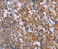 Immunohistochemistry of paraffin-embedded Human thyroid cancer using GAD1 Polyclonal Antibody at dilution of 1:40