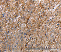 Immunohistochemistry of paraffin-embedded Human esophagus cancer using GRPR Polyclonal Antibody at dilution of 1:40