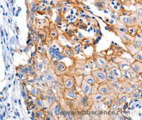 Immunohistochemistry of paraffin-embedded Human cervical cancer using Claudin 1 Polyclonal Antibody at dilution of 1:150