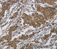 Immunohistochemistry of paraffin-embedded Human gastric cancer tissue using Claudin 8 Polyclonal Antibody at dilution 1:50