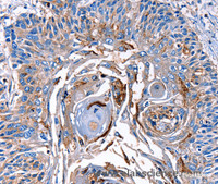 Immunohistochemistry of paraffin-embedded Human esophagus cancer tissue using LRP2 Polyclonal Antibody at dilution 1:40