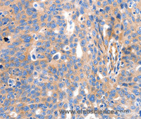 Immunohistochemistry of paraffin-embedded Human ovarian cancer tissue using IGFBP7 Polyclonal Antibody at dilution 1:50