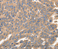 Immunohistochemistry of paraffin-embedded Human ovarian cancer using IRF1 Polyclonal Antibody at dilution of 1:40