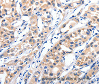 Immunohistochemistry of paraffin-embedded Human lung cancer tissue using JAK2 Polyclonal Antibody at dilution 1:35