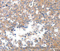 Immunohistochemistry of paraffin-embedded Human breast cancer using JNK1 Polyclonal Antibody at dilution of 1:50