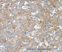 Immunohistochemistry of paraffin-embedded Human breast cancer using BPIFB2 Polyclonal Antibody at dilution of 1:50