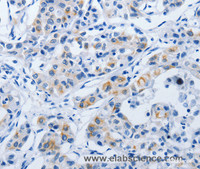 Immunohistochemistry of paraffin-embedded Human lung cancer using BPIFB3 Polyclonal Antibody at dilution of 1:50