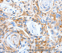 Immunohistochemistry of paraffin-embedded Human esophagus cancer tissue using LRIG3 Polyclonal Antibody at dilution 1:50