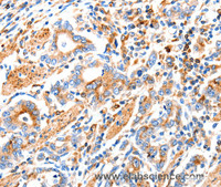 Immunohistochemistry of paraffin-embedded Human gastic cancer using MAP2K2 Polyclonal Antibody at dilution of 1:100