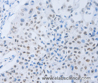 Immunohistochemistry of paraffin-embedded Human lung cancer tissue using c-Fms Polyclonal Antibody at dilution 1:45