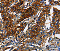 Immunohistochemistry of paraffin-embedded Human lung cancer using ABCC5 Polyclonal Antibody at dilution of 1:50