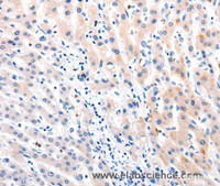 Immunohistochemistry of paraffin-embedded Human liver cancer tissue using MTOR Polyclonal Antibody at dilution 1:60