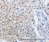 Immunohistochemistry of paraffin-embedded Human lung cancer using 14-3-3 theta Polyclonal Antibody at dilution of 1:50