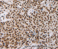 Immunohistochemistry of paraffin-embedded Human esophagus cancer using AKAP8 Polyclonal Antibody at dilution of 1:30