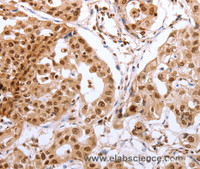 Immunohistochemistry of paraffin-embedded Human lung cancer tissue using PTTG1 Polyclonal Antibody at dilution 1:60