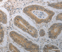 Immunohistochemistry of paraffin-embedded Human colon cancer tissue using SHH Polyclonal Antibody at dilution 1:70