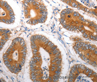 Immunohistochemistry of paraffin-embedded Human colon cancer tissue using SLC12A6 Polyclonal Antibody at dilution 1:40