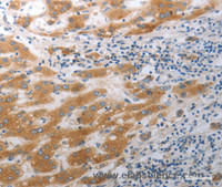 Immunohistochemistry of paraffin-embedded Human liver cancer tissue using SLC12A6 Polyclonal Antibody at dilution 1:40