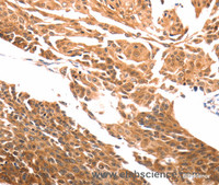 Immunohistochemistry of paraffin-embedded Human cervical cancer using SLC39A6 Polyclonal Antibody at dilution of 1:30