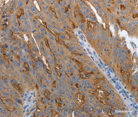 Immunohistochemistry of paraffin-embedded Human ovarian cancer using SLC34A2 Polyclonal Antibody at dilution of 1:70