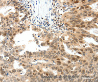 Immunohistochemistry of paraffin-embedded Human ovarian cancer tissue using TOP2A Polyclonal Antibody at dilution 1:30