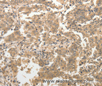 Immunohistochemistry of paraffin-embedded Human gasrtic cancer tissue using ADAR Polyclonal Antibody at dilution 1:40