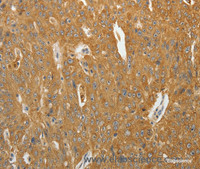 Immunohistochemistry of paraffin-embedded Human ovarian cancer using AKR1B1 Polyclonal Antibody at dilution of 1:40