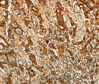 Immunohistochemistry of paraffin-embedded Human gastric cancer using AKR1B1 Polyclonal Antibody at dilution of 1:40