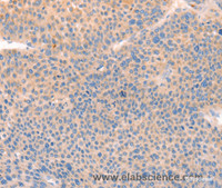 Immunohistochemistry of paraffin-embedded Human liver cancer tissue using CD109 Polyclonal Antibody at dilution 1:30