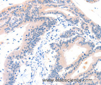 Immunohistochemistry of paraffin-embedded Human colon cancer tissue using ITGA6 Polyclonal Antibody at dilution 1:50