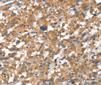 Immunohistochemistry of paraffin-embedded Human thyroid cancer tissue using VE-Cadherin Polyclonal Antibody at dilution 1:50