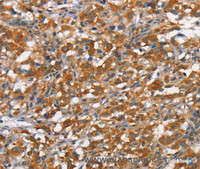 Immunohistochemistry of paraffin-embedded Human thyroid cancer tissue using CD168 Polyclonal Antibody at dilution 1:40