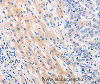 Immunohistochemistry of paraffin-embedded Human lung cancer tissue using MUC2 Polyclonal Antibody at dilution 1:60