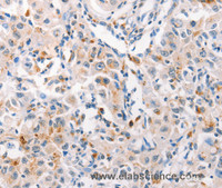 Immunohistochemistry of paraffin-embedded Human liver cancer tissue using MUC2 Polyclonal Antibody at dilution 1:60