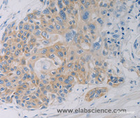 Immunohistochemistry of paraffin-embedded Human esophagus cancer using CD303 Polyclonal Antibody at dilution of 1:50