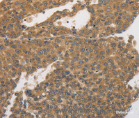 Immunohistochemistry of paraffin-embedded Human liver cancer tissue using PRKD1 Polyclonal Antibody at dilution 1:30