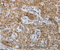 Immunohistochemistry of paraffin-embedded Human lung cancer tissue using PTPRM Polyclonal Antibody at dilution 1:40