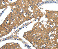 Immunohistochemistry of paraffin-embedded Human breast cancer tissue using SCN5A Polyclonal Antibody at dilution 1:30