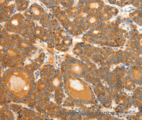 Immunohistochemistry of paraffin-embedded Human thyroid cancer tissue using SCT Polyclonal Antibody at dilution 1:40