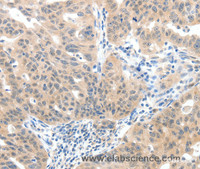 Immunohistochemistry of paraffin-embedded Human ovarian cancer tissue using SLC20A1 Polyclonal Antibody at dilution 1:40