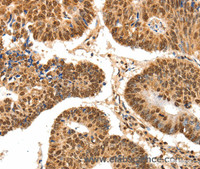 Immunohistochemistry of paraffin-embedded Human colon cancer tissue using SPATA20 Polyclonal Antibody at dilution 1:70