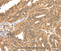 Immunohistochemistry of paraffin-embedded Human ovarian cancer tissue using SPATA20 Polyclonal Antibody at dilution 1:70