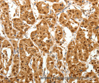 Immunohistochemistry of paraffin-embedded Human lung cancer tissue using TNN Polyclonal Antibody at dilution 1:40