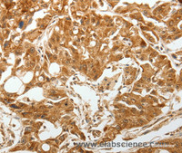 Immunohistochemistry of paraffin-embedded Human lung cancer tissue using TGF β Receptor I Polyclonal Antibody at dilution 1:60