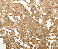 Immunohistochemistry of paraffin-embedded Human lung cancer using TXN Polyclonal Antibody at dilution of 1:40