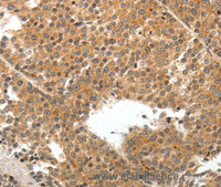 Immunohistochemistry of paraffin-embedded Human liver cancer tissue using TEK Polyclonal Antibody at dilution 1:50