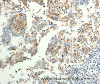 Immunohistochemistry of paraffin-embedded Human gastric cancer tissue using TRPC6 Polyclonal Antibody at dilution 1:40